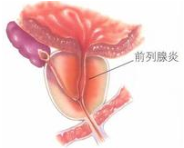前列腺的病因
