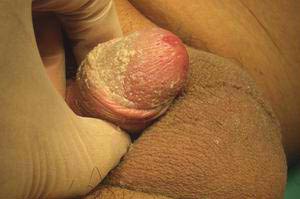 包皮炎的治療方法有哪些