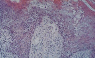 尖銳濕疣的發病原因