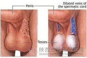 患了精索靜脈曲張必須手術治療嗎?