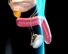 無(wú)精癥治療方法“助您告別無(wú)精時(shí)代”