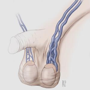 精索靜脈曲張的發(fā)病原因是什么?