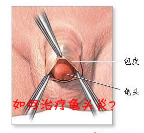 包皮龜頭炎怎么治療