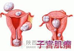 治療子宮肌大概要花多少錢